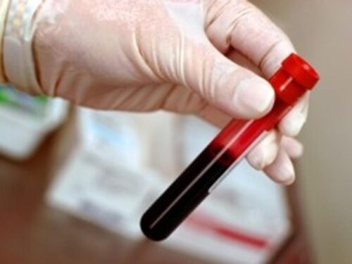 un-analisis-de-sangre-podria-determinar-riesgo-de-ictus