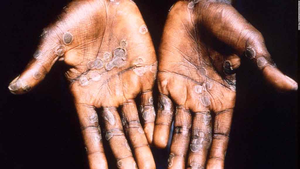 oms-preocupada-por-variante-de-mpox-extendida-por-rdc