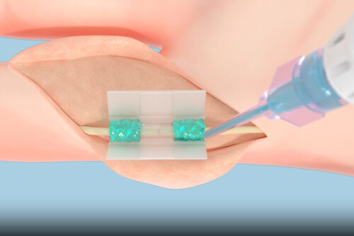 nueva-tecnologia-para-sustituir-suturas-y-grapas-en-cirugias