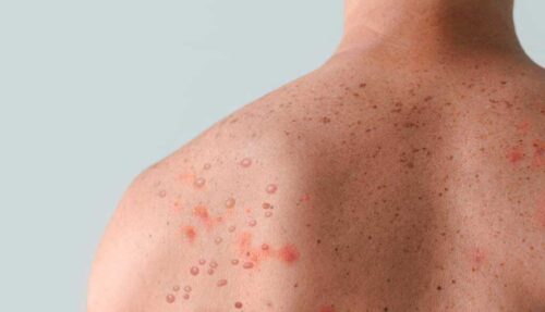 uruguay-alerta-por-rebrote-de-sarampion-en-la-region