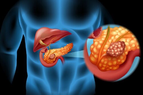 italia-muestra-avances-en-la-lucha-contra-el-cancer-de-pancreas
