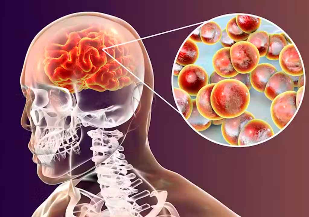 italia-reporta-mas-de-mil-casos-anuales-de-meningitis