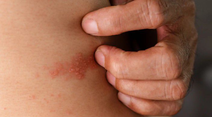 advierten-en-vietnam-aumento-de-casos-graves-de-varicela-en-adultos